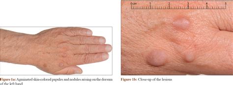 Bilateral Agminated Skin Colored Papules And Nodules On The Dorsum Of The Hands Indian Journal