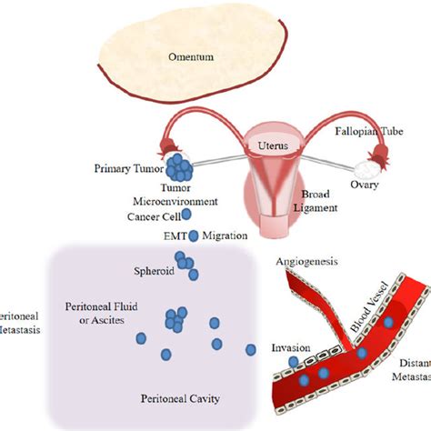 Model Of Ovarian Cancer Progression Including Cancer Cell Download