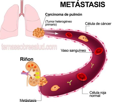 Es un esquema simple pero claro del proceso de metástasis o sea de la