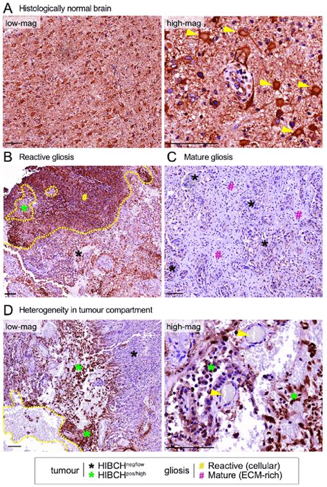 Ihc Analysis Of Hibch Expression In Human Triple Negative Breast Cancer