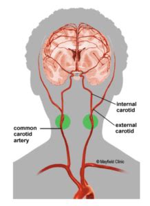 Carotid Artery Stenosis – Hope For Hearts