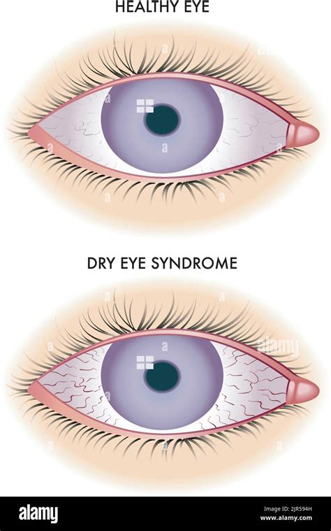 Symbolic Medical Illustration Shows One Healthy Eye And One Affected By