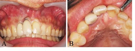 Figure 1 From Nasopalatine Duct Cyst Associated With Dental Implant