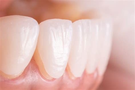 Emax Laminate Veneers Implant Treatment In Turkey Implant Prices