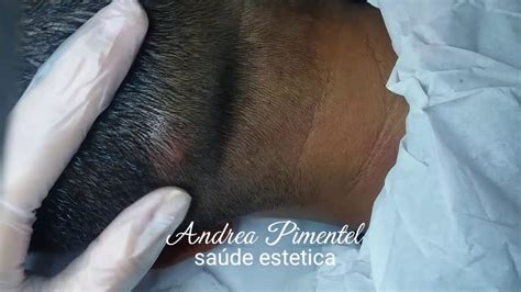 Cisto Sebaceo Ou Epidermico Andrea Pimentel Neuroest Tica Youtube