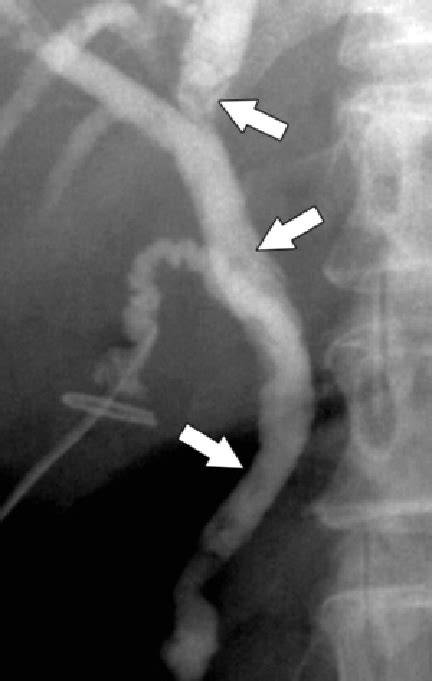 Biliary Flukes C Sinensis T Tube Cholangiogram Shows Biliary Worms