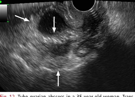 Figure 2 From Ultrasonography Of Ovarian Masses Using A Pattern