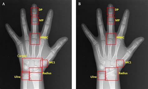 Improvement Of Bone Age Assessment Using A Deep Learning Model In Young