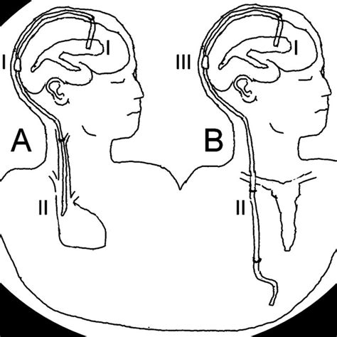 The Cerebrospinal Fluid Csf Shunt System A Ventriculo Atrial Shunt