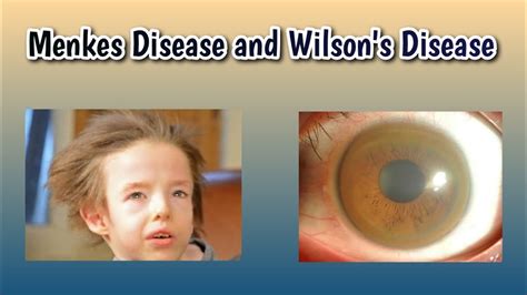 Difference Between Menkes Disease And Wilson S Disease Wilsonsdisease Menkesdisease Neetpg