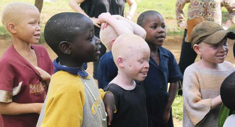 Protect Albino Children - FoCT