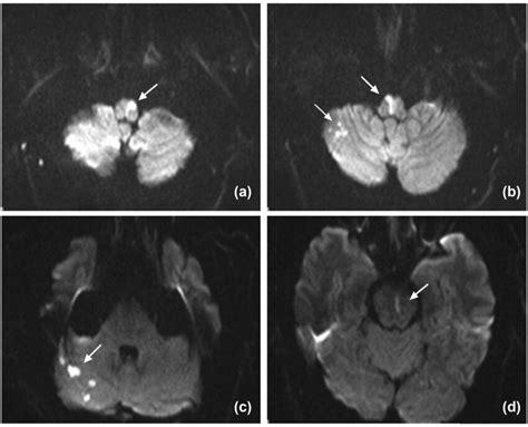 Axial Dwi Imaging A And B Arrow Bilateral Medial Medullary