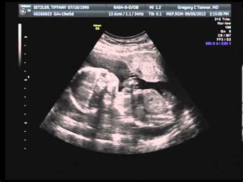 Week Ultrasound Artofit