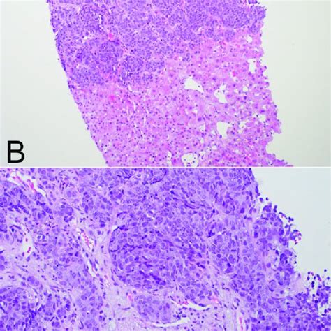 Hande Stained Sections Of Core Biopsy Demonstrating Basaloid Nests Of