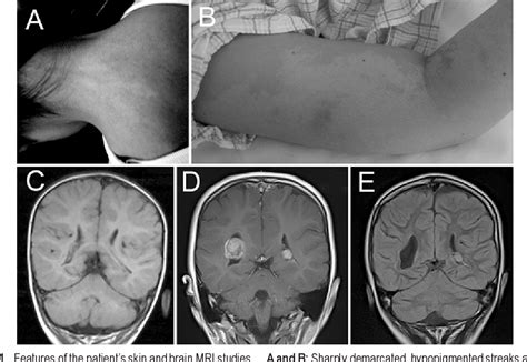 Pdf Choroid Plexus Papilloma In A Girl With Hypomelanosis Of Ito