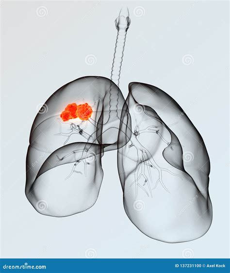 Lung Cancer Medically D Illustration On Light Background Stock Photo