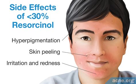 Resorcinol - Everything You Need to Know - Acne.org