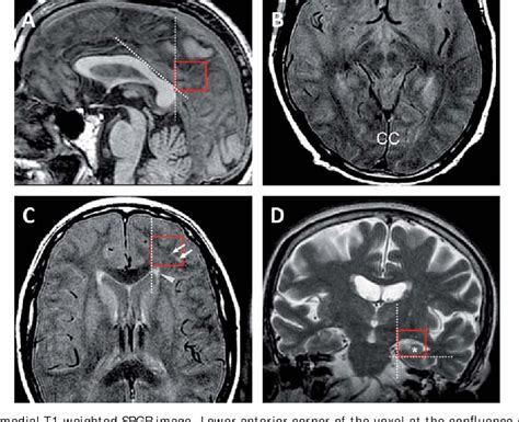 Figure 1 From Regional Effects Of Age And Sex In Magnetic Resonance