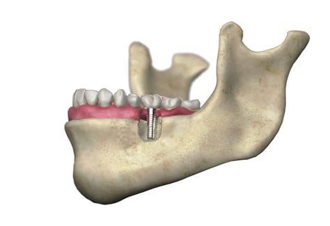 Osteonecrosis Of The Jaw Causes Symptoms And Treatment