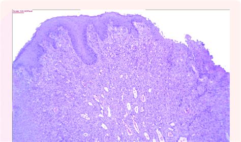 C X Photomicrograph Showing Vascular Arrangement Of Pyogenic