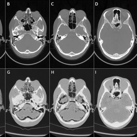 Comparison Of Ct Scans From The Subject And The 3d Printed Phantom Download Scientific Diagram