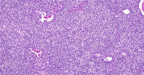 Epstein Barr Virusassociated Extranodal Marginal Zone Lymph