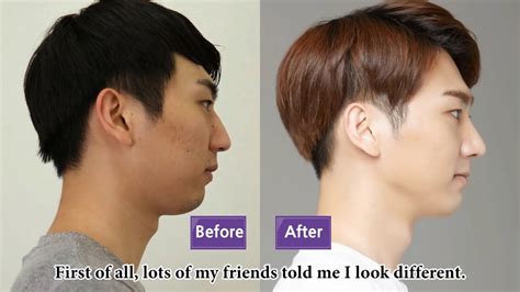 Real Experiences Of Having Rhinoplasty In South Korea Jw Plastic