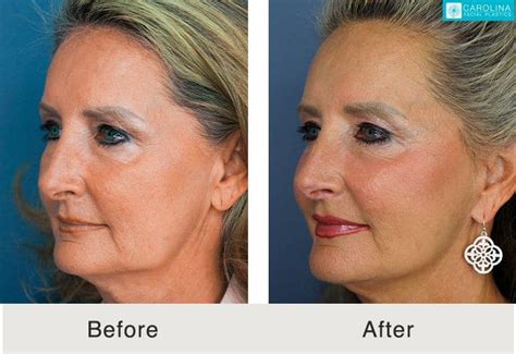 Non Surgical Neck Lift In Charlotte NC Carolina Facial Plastics