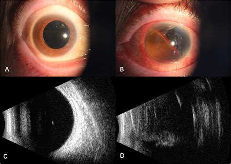 Frontiers Case Report Intraocular Hemorrhage In A Primary