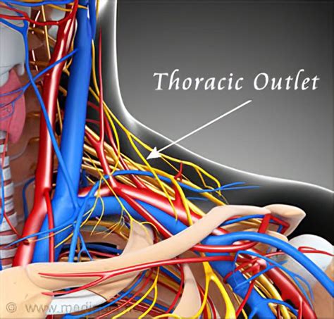 Thoracic Outlet Syndrome Tos Treatment Symptoms Causes