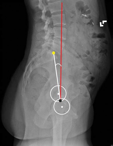 Pelvic Anatomy Xray Interpreting X Rays Of The Pelvis Hip Joint And