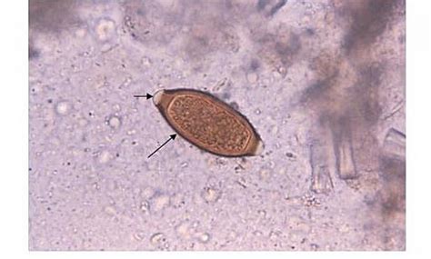 Trichuris Trichiura Whipworm Symptoms Morphology Egg Life Cycle