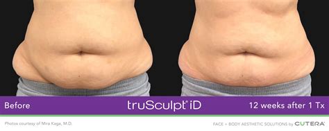 Trusculpt Id Woodlands Body Contouring Tamina Tx