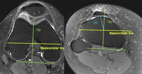 Patellar Tilt And Patellar Tendontrochlear Groove Angle Present The