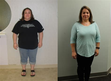 Jennifers Weight Loss Transformation St Louis Bariatrics