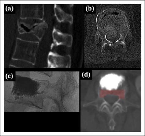 Osteoporotic Vertebral Fracture