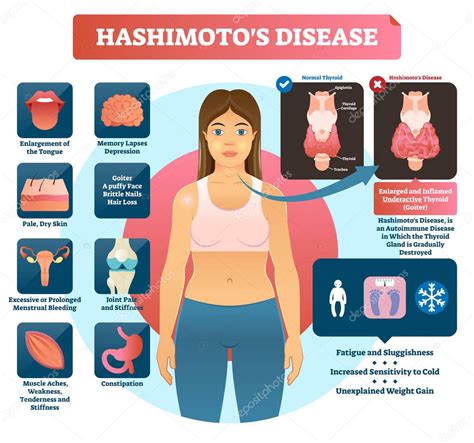 Hashimotos Tiroiditis Vector Ilustración Diagrama Médico Etiquetado 2024