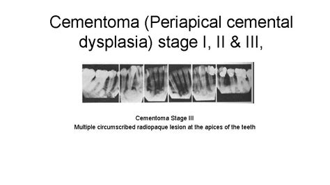 Periapical Pathology PAP Periapical Abscess Granuloma Periodontal Cyst