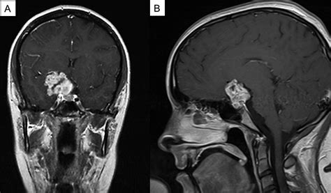 Chondrosarcoma Mri