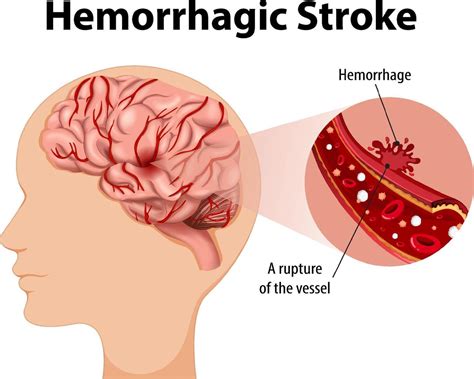 Human With Hemorrhagic Stroke 8337646 Vector Art At Vecteezy