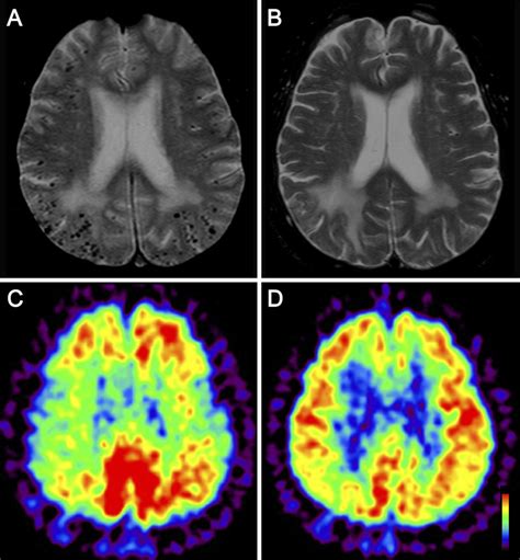 Figure1 MRI And PET Scans Of Case 1 A Brain MRI Showed Cortical And