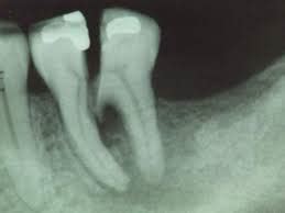 Cracked Tooth Syndrome ToothWiz Dental