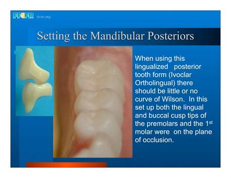 Complete Dentures 16occlusal Schemes Lingualized Occlusion Ppt