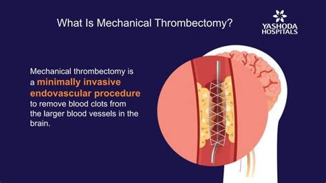 Mechanical Thrombectomy For Acute Ischemic Stroke Brain Stroke