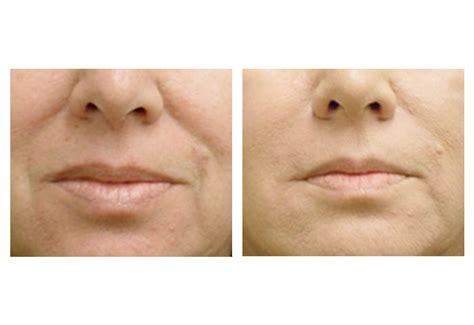 Soft Tissue Fillers: Restylane, Juvederm, Perlane and Radiesse | San ...