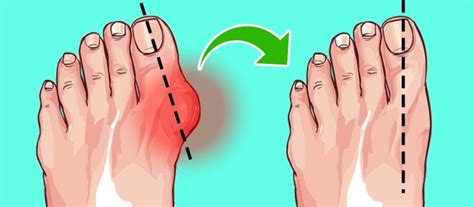 5 Ways To Naturally Shrink Your Bunions Without Surgery Women Daily