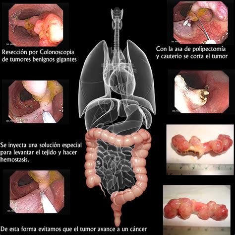 Cáncer del Colon Gastroenterologia El Salvador murrasaca