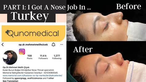 I GOT A NOSE JOB IN TURKEY ISTANBUL PART 1 QUNOMEDICAL Op Dr