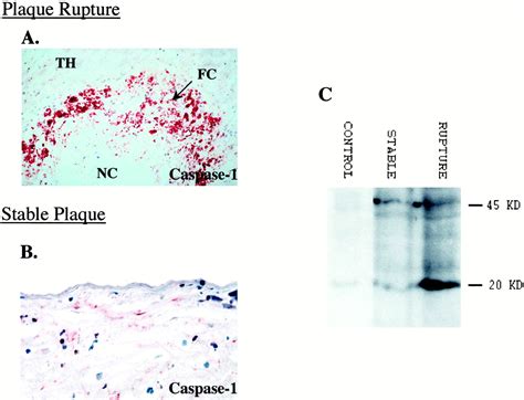 Localization Of Apoptotic Macrophages At The Site Of Plaque Rupture In