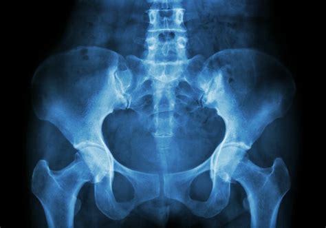 Pinzamiento femoroacetabular Causas síntomas y tratamientos